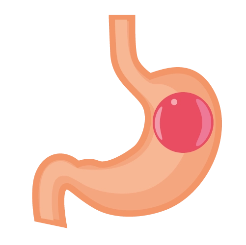 gastric balloon turkey