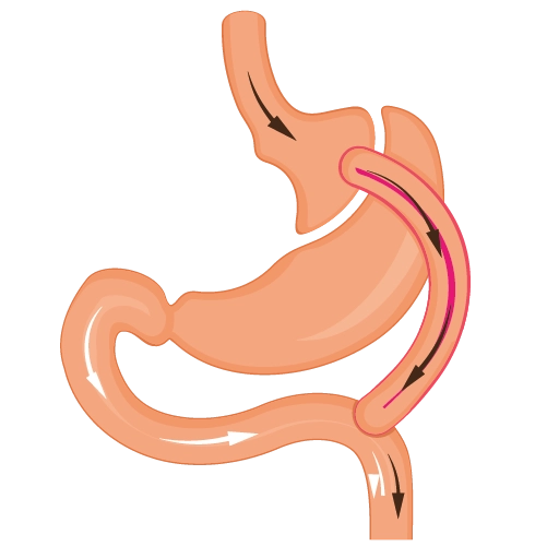 gastric bypass turkey