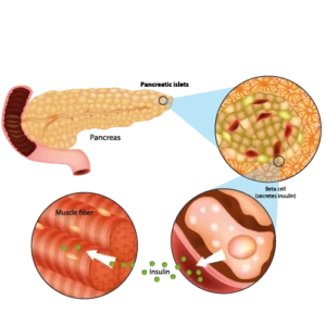 metabolic Surgery for type 2 diabetic turkey