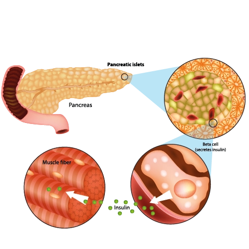 metabolic Surgery for type 2 diabetic turkey