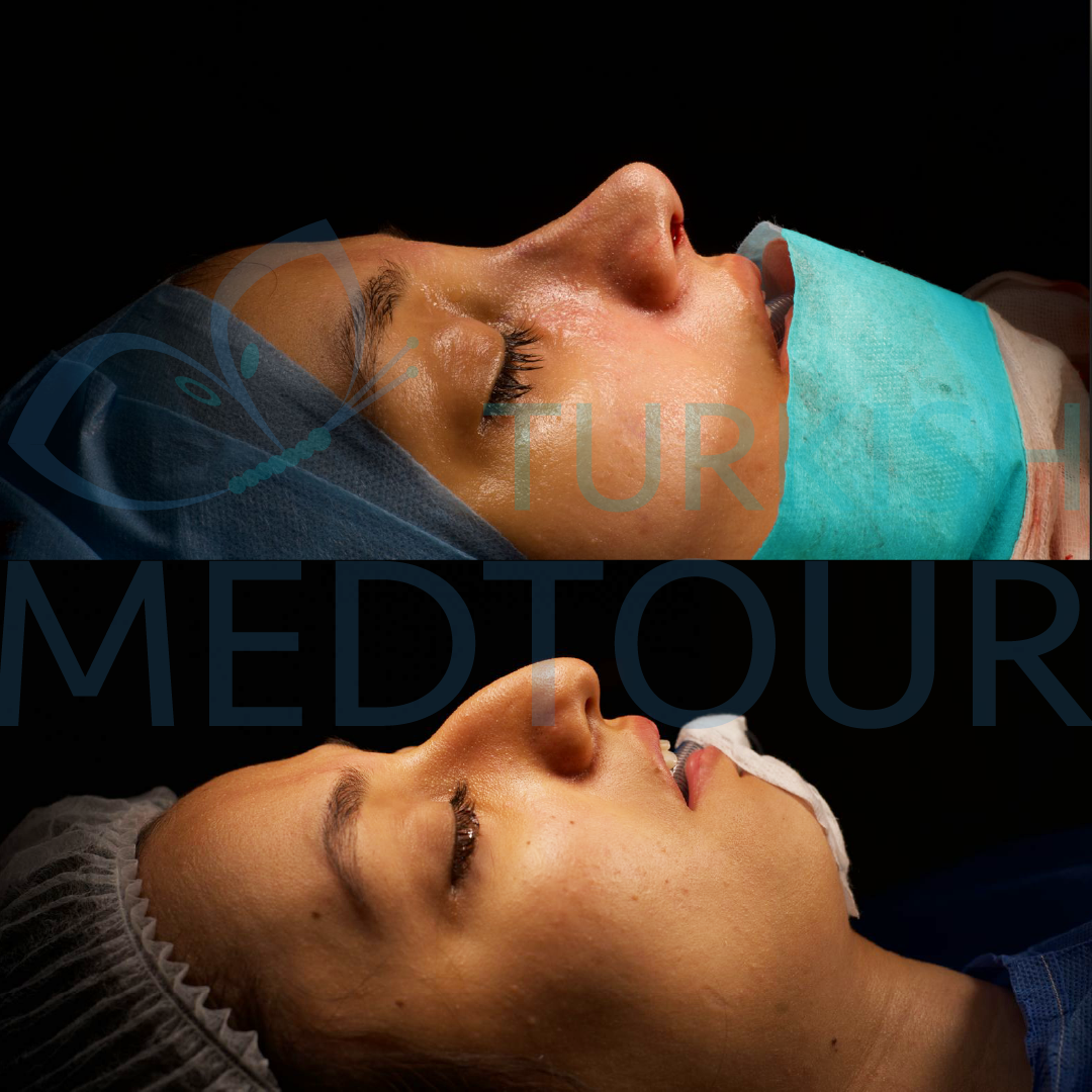 rhinoplasty after-before1