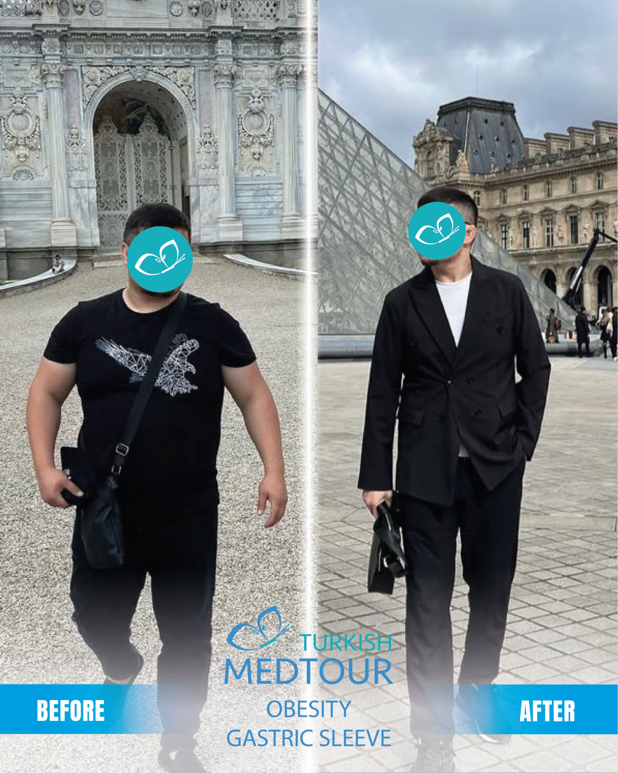 Gastric sleeve before after