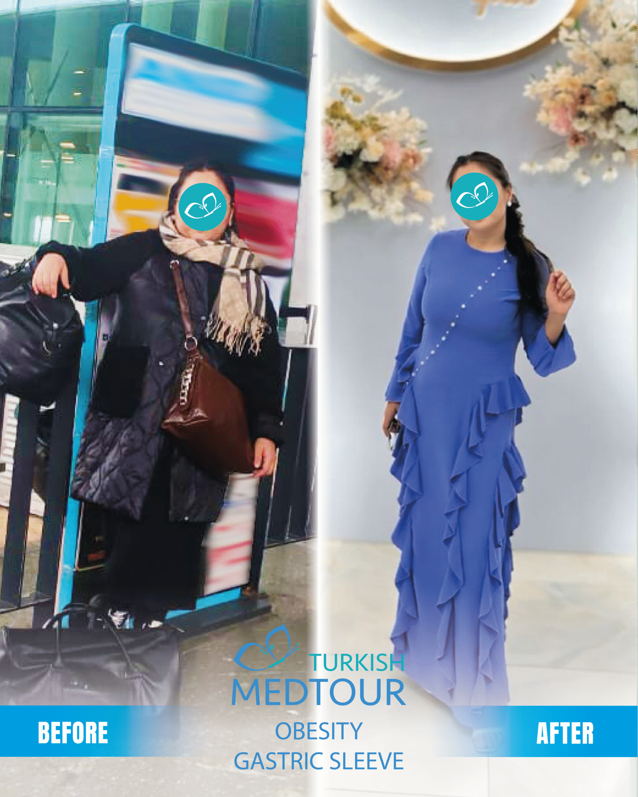 Gastric Sleeve before after